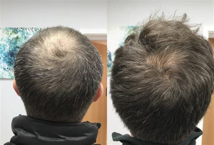 Fans Wonder If Udonis Haslem Has Had Head Injury or Is It Hair Loss Resulting In Bald Spots