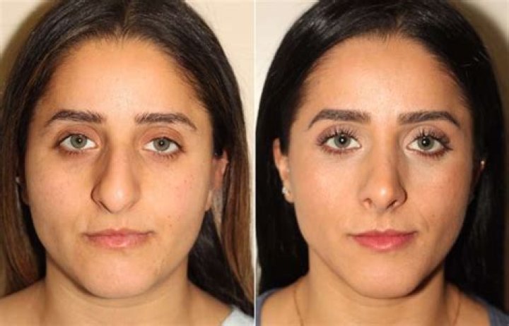 Herlene Nicole Budol New Look and Nose After Rhinoplasty, Before And After Plastic Surgery Photos