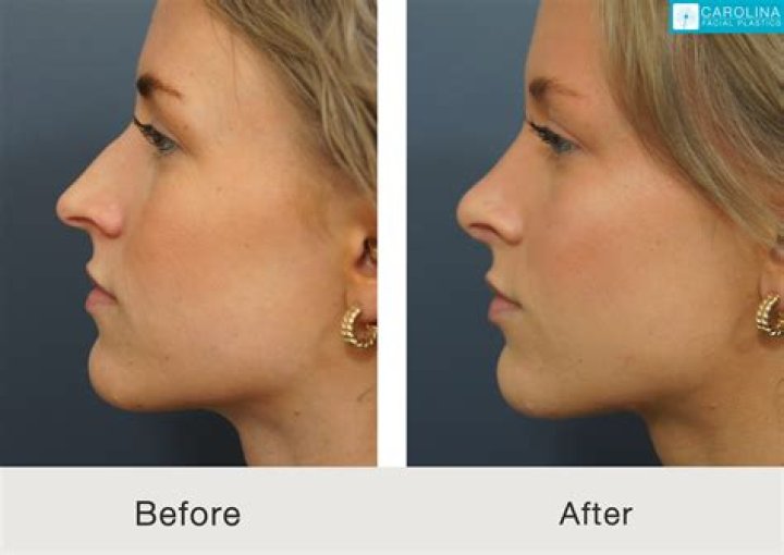 Juliette Porter Plastic Surgery Explained: Nose Job, Teeth Veneer and more