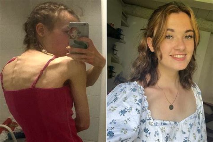 Kirra Hughes’ Health Has Fans Worried After Anorexia -What’s Happened To Her?