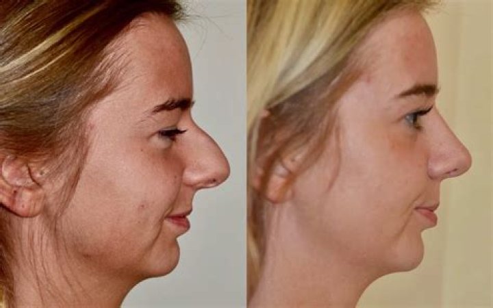 Mai Pham Nose Job | Before And After Photos