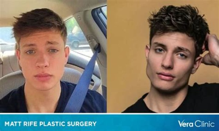 Matt Rife’s Plastic Surgery: Did The Comedian Have a Glow-Up or Did He Get Cosmetic Procedures? Check Out His Before and After Pictures!